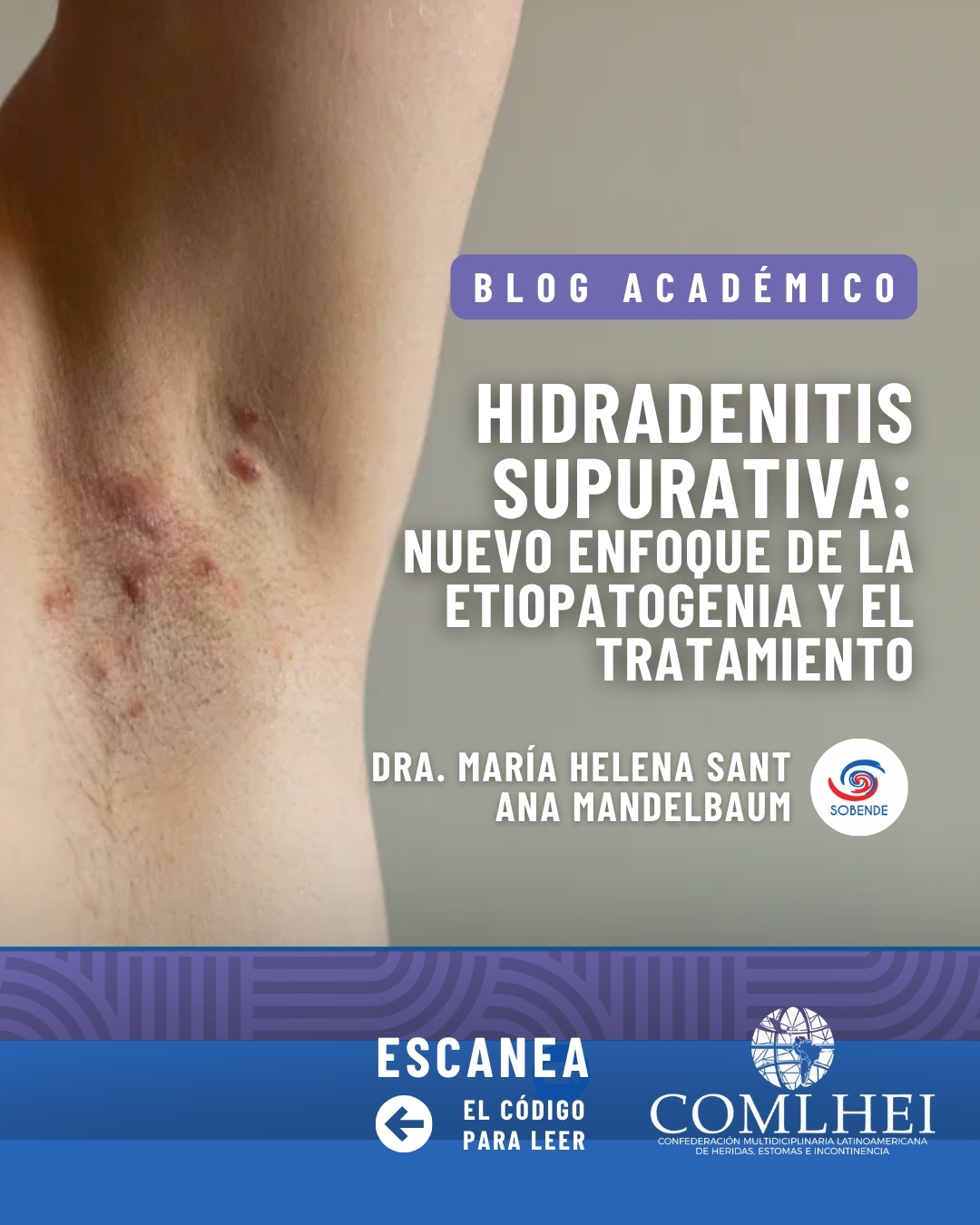 Hidradenitis supurativa: Nuevo enfoque de la etiopatogenia y el tratamiento